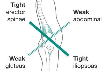 Lower Cross syndrome