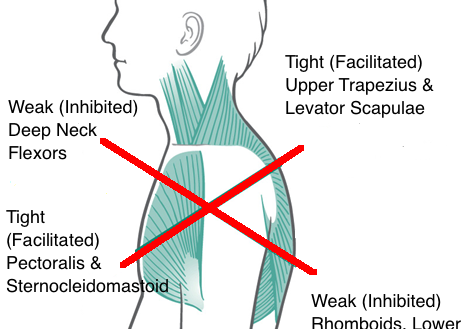 Upper cross syndrome